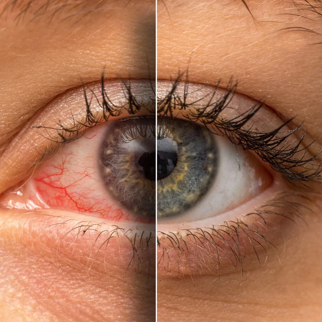 Eye Care